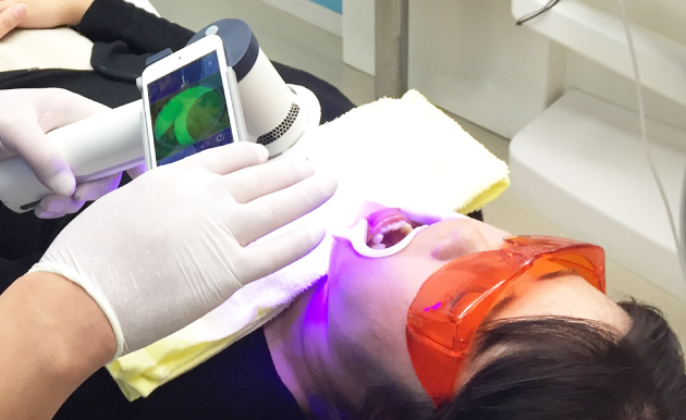 口腔内蛍光観察装置、ベルスコープ